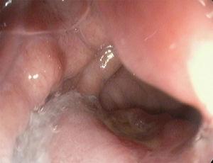 Imagen endoscópica. Úlcera de boca anastomótica.