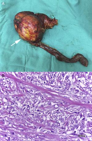 A) Fotografía de la pieza de DPC que evidencia el tamaño de la lesión (flecha blanca). B) Microscopía (×400) de la lesión con tinción de hematoxilina-eosina.