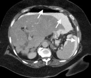 Tomografía computarizada abdominal que muestra neumoperitoneo y líquido peritoneal libre con evidencia de fuga de medio de contraste (flechas). Debido a estos hallazgos, el paciente se sometió a laparoscopia de urgencia.
