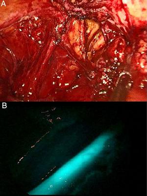 A) Imagen sin filtro en el que se aprecia conglomerado inflamatorio en la teórica localización del uréter izquierdo. B) Visualización del ICG en la luz del uréter tras la inyección retrógrada por el catéter ureteral.