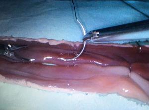 Inicio de puntos sueltos de sostén en anastomosis entero-entérica latero-lateral manual con vísceras «ex vivo» porcinas en un endotrainer laparoscópico.