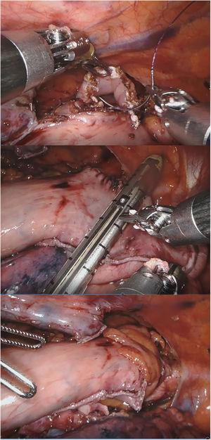Anastomosis manual robótica término-lateral en prono en el Ivor-Lewis. 2-1: inicio de la sutura barbada en cara anterior; 2-2: sección de la plastia gástrica redundante; 2-3: omentoplastia.