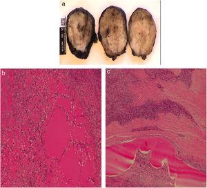 Anatomía patológica: A) Se observa una formación ovoidea correspondiente a una tumoración mesenquimal multinodular seudoencapsulada. B y C) Se identifican algunos focos de aspecto mixoide compatible con tumor fibromixoide osificante maligno.