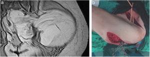 a. Imagen RMN de LS-WD «en reloj de arena». b. Doble incisión abdominal y glútea.