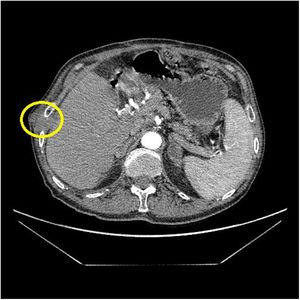 Tomografía axial computarizada abdominal (corte axial): nódulo en tejido celular subcutáneo de 3cm en parrilla costal derecha.