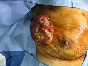 Tumoración exofítica indurada y ulcerada de unos 5×6cm en mama derecha.