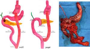 a) Esquema de la anatomía preoperatoria: BPGY y ampuloma; b) Esquema de la reconstrucción anatómica postoperatoria; c) Pieza quirúrgica de duodenopancreatectomía cefálica y gastrectomía del remanente gástrico.