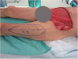 Defecto infraumbilical de 24×17cm que incluye fascia prerrectal resultante tras 5 sesiones de cirugía de Mohs. Diseño de colgajo fasciocutáneo anterolateral de muslo izquierdo.