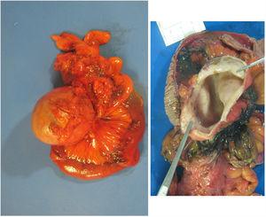 Segmento de intestino delgado que presenta a nivel del mesenterio una tumoración de 8,5x6x6 cm quística con contenido de aspecto achocolatado.