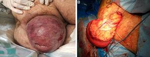 A) Gran prolapso rectal incarcerado. Se aprecia mucosa congestiva, con áreas necróticas y ulceración. B) Detalle de la intervención quirúrgica. Tras incisión circunferencial a nivel de línea pectínea, exéresis de recto prolapsado.