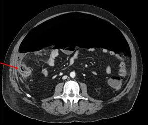 Corte axial de la tomografía computarizada con contraste del paciente en el que se observa abundante neumoperitoneo y cambios inflamatorios en ciego (flecha roja), hallazgos que sugieren perforación cecal.