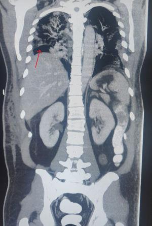 Corte coronal de TC toracoabdominal en el que se objetiva neumoperitoneo subdiafragmático derecho (flecha roja). Contraste en colon descendente, sin datos de fuga. Neumonía bilateral extensa de origen por COVID-19.