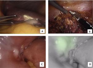 A) Pequeño nódulo hepático. B) Implante en peritoneo parietal a nivel de fosa iliaca izquierda. C) Nódulo peritoneal a nivel de intestino delgado. D) Hiperrefringencia mediante fluorescencia en nódulo de intestino delgado.