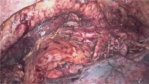 Visión del campo quirúrgico tras la fase resectiva (toracoscopia derecha en prono).