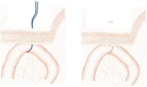 Yeyunostomía «fantasma» referenciada con vesell loop o fijada al peritoneo parietal con marcaje cutáneo.