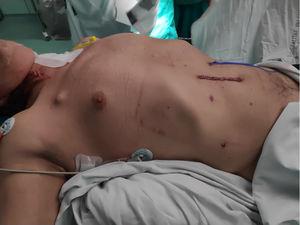 Exposición de las heridas quirúrgicas, vesell loop de la yeyunostomía «fantasma», sin colocación de sondas ni drenajes.