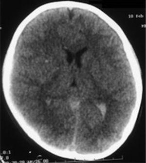 Tomografía de cráneo a su ingreso a urgencias con edema cerebral severo, hemorragia subaracnoidea y desviación importante de la línea media.