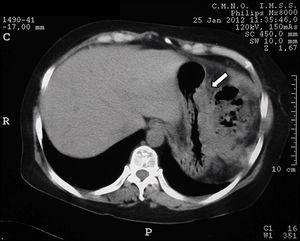 Tomografía axial computada con reacción xantogranulomatosa en curvatura mayor de estómago.