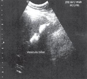 Ultrasonografía que concluye el diagnóstico de colecistolitiasis.