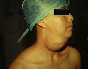 Caso 2. Linfangioma submandibular derecha, de 12×10cm no doloroso, con cicatriz de cirugía previa.