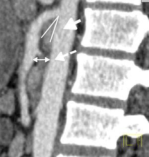 Tomografía axial computada con contraste oral e intravenoso en fase arterial, donde se observa disminución del ángulo de la arteria mesentérica superior (flecha continua) y de la distancia aortomesentérica (flecha discontinua).