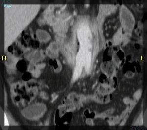 Tomografía axial computada, corte axial que mostró un halo hipodenso en el segmento proximal del bypass, con la presencia de aire en íntimo contacto con la tercera porción duodenal y visualizándose una dudosa línea de contigüidad con luz intestinal.