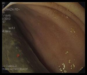 Endoscopia digestiva superior. P: exposición de prótesis de dacron a través de la luz duodenal.
