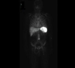 Gammagrafía marcada con leucocitos sugestiva de infección protésica.