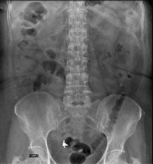 Caso 1. Radiografía inicial de colon por enema, antero-posterior de abdomen, se visualiza objeto radiolúcido compatible con prótesis dental.