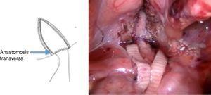Anastomosis ureterovesical transversa terminada.