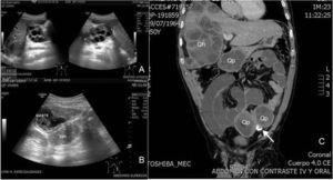 A)El ultrasonido abdominal muestra imágenes heterogéneas multiquísticas en hígado. B)Imagen quística adherida a asa de intestino delgado. C)Corte coronal de tomografía computada de abdomen que muestra múltiples lesiones quísticas en hígado (Qh), en peritoneo (Qp) y una calcificada entre ellas (flecha).