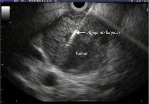 Imagen de ultrasonido endoscópico con masa pancreática bien definida y aguja de biopsia para la obtención de una muestra de la lesión.