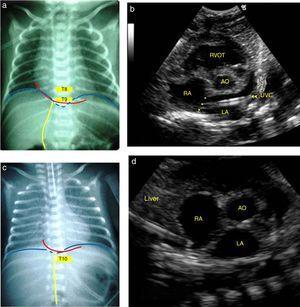 Anteroposterior chest X-ray showing the umbilical venous catheter in T9, just above the diaphragm and cavoatrial junction, interpreted as well positioned (a) and corresponding echocardiographic image (b) demonstrating the distal end of the catheter in the left atrium, after crossing the interatrial septum (*). In another newborn, the radiographic image showed the catheter between T9 and T10, below the diaphragm and cavoatrial junction, suggesting it is positioned in the liver (c), but its end was correctly identified in the inferior vena cava junction with the right atrium by the echocardiography (d). LA, left atrium; RA, right atrium; AO aorta; UVC, umbilical venous catheter; RVOT, right ventricular outflow tract.