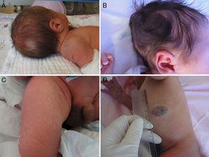 (A) Poliosis; (B), melanocytic nevus on the scalp; (C) neonate skin desquamation; (D) hemangioma.