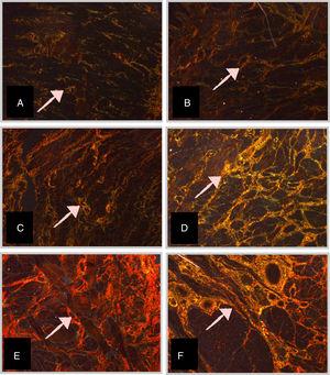 Micrographs of stillborn tongue fragments examined under polarized light, showing the birefringent collagen fibers (arrows) (Picrosirius – 10×–320× final magnification) at different gestational ages (GA). (A) GA: 23 weeks; (B) GA: 28 weeks; (C) GA: 34 weeks; (D) GA: 37 weeks; (E) GA: 39 weeks, and (F) GA: 40 weeks.
