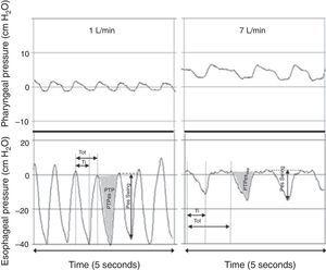 Simultaneous recordings of pharyngeal (top) and esophageal (bottom) pressures from an infant receiving 1L/min (left) and 7L/min (right) through a nasal cannula. Although there is a notable increase in pharyngeal pressure during higher flow conditions, virtually no increase is observed in end-expiratory pressure measured at the thoracic level. The application of 7L/min flow significantly decreased the intrathoracic pressure swings through an attenuation of the negative inspiratory pressure. Adapted from Milési et al.15