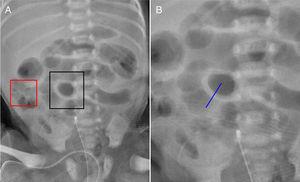 (A) abdominal radiography with bowel wall thickening (BWT) and normal loop circumscribed by the black box and the red box, respectively; (B) line from BWT, perpendicular to the bowel wall, identified by the radiologist.