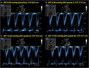 Doppler echocardiographic examination performed during the abdominal compression maneuver. A progressive reduction in aortic velocity-time integral occurs as abdominal pressure increases. IAP, intra-abdominal pressure; IAH, intra-abdominal hypertension; VTI, aortic velocity-time integral.