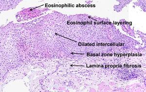 Histological features observed in EoE (Hematoxylin & Eosin, 10 ×).