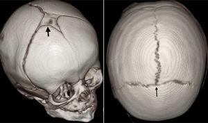 Computed tomography image with three-dimensional reconstruction of the skull in healthy children. The anterior fontanel could be opened (thick black arrow; left) or closed or fused (thin black arrow) in a 4-month-old boy (right).