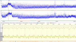 An example of how seizures appear on aEEG and raw EEG. [Authors' personal file].