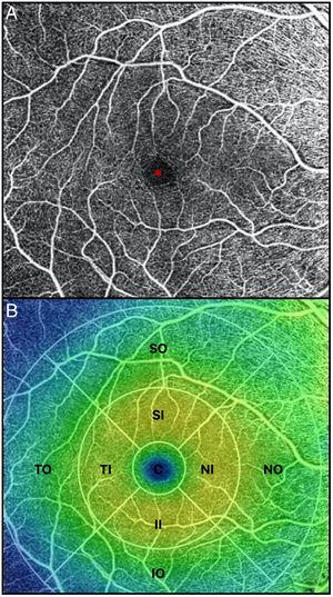 (A) OCTA of the macular region, showing an angiogram of the retinal circulation in the superficial capillary plexus. The image depicts the retinal arteries and veins within the macular region in a binarized OCTA image, which represents the blood vessels in white color. The central area devoid of vessels represents the foveal avascular zone (*). (B) Color image with ETDRS sectors, depicting the 9 sectors of the ETDRS grid in the macular region. The fovea is represented by the central circle (C). Both inner (I) and outer (O) rings are further subdivided into superior (S), nasal (N), inferior (I) and temporal (T) region.