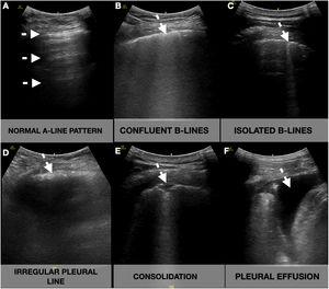 Lung ultrasound showing the different signs (white arrow). A-lines: horizontal reverberation artifacts parallel to the pleural line (A); B-lines: hyperechoic vertical artifacts that arise from the pleural line, extending to the bottom of the screen without fading that erases the A-line artifact, that can converge (B) or be well demarcated (C); Irregular pleural line: indented or broken pleural line (D); Consolidations: subpleural hypoechoic areas surrounded by a hyperechoic artifact tail (E); Pleural effusion: anechoic space between the parietal and visceral pleura (F).
