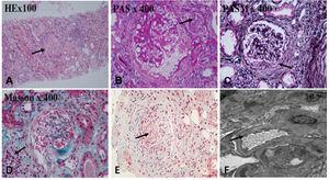 The renal biopsy findings of the patient. Renal biopsy was routinely stained with HE, PAS, PASM, Masson. (A) 50% of glomerulus sclerosis (arrow), (B) vacuolar and granular degeneration of renal tubular epithelium(arrow), (C) crescent formation(arrow), (D) multifocal inflammatory cell infiltration in the renal interstitium with fibrosis (arrow), (E) thickening of the arterial wall, segmental hyaline degeneration, and suspicious fibrinoid necrosis of one of the arterioles(arrow). (F) There was no obvious thickening of the glomerular basement membrane, extensive fusion of the foot processes (arrow), and no exact electron dense deposits were found.