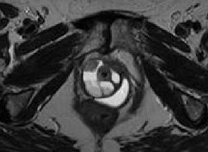 T2 axial: lesión quística tabicada uretral con un nivel en su interior. Masa sólida en el margen anterior.