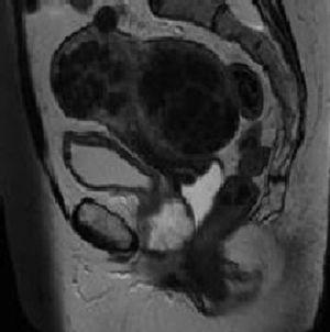 T2 sagital: lesión multiquística que depende de la uretra y abomba posteriormente la pared vaginal anterior. En el margen anterior se distingue una masa sólida nodular. Se muestra en la imagen un útero aumentado de tamaño con múltiples lesiones nodulares hipointensas, correspondiente a un útero miomatoso.