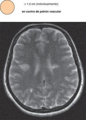 Imágenes Puntiformes Hiperintensas En La Sustancia Blanca: Una ...