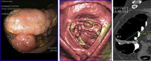 Adenocarcinoma de colon, lesión prominente de superficie polilobulada que reduce la luz del colon. Excelente correlación entre la colonoscopia convencional y la colonografía-TC. En la imagen multiplanar, el CCR sigue el eje del pliegue y no se detecta invasión de planos profundos (T2).