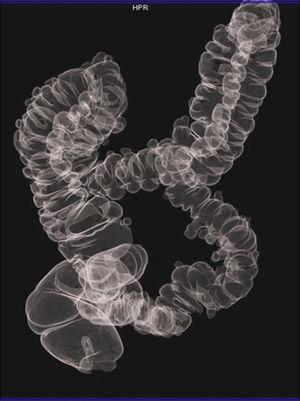 Importante enfermedad diverticular del colon. La segmentación del colon de la colonografía-TC aporta una imagen similar al EBDC, que proporciona un mapa topográfico de los divertículos.