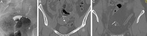 Migración a la cavidad peritoneal. A) Histerosalpingografía. Se identifican dos Essure en posición anómala. El derecho en posición inferior, ha migrado a la cavidad peritoneal (D). El marcador medial del Essure izquierdo (flecha) está en la cavidad uterina, y el Essure izquierdo (I) perfora la pared uterina. Trompa izquierda permeable (T), derecha no permeable. B) TC reconstrucción coronal. Posición del Essure izquierdo (I) y del marcador medial (flecha) en la cavidad uterina. C) TC reconstrucción coronal. Los mismos datos del Essure derecho (D).